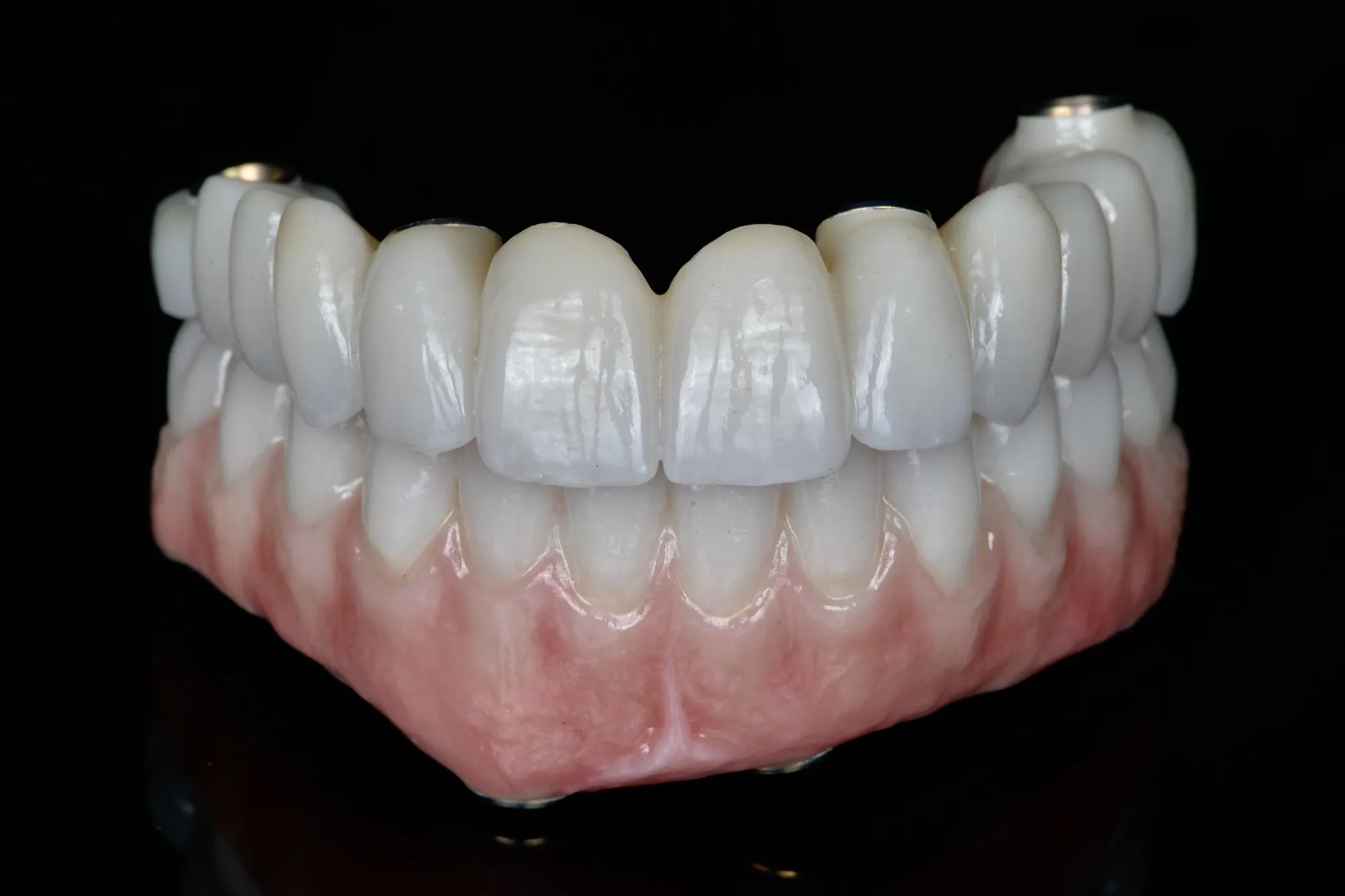 Prótesis de zirconia monolítica