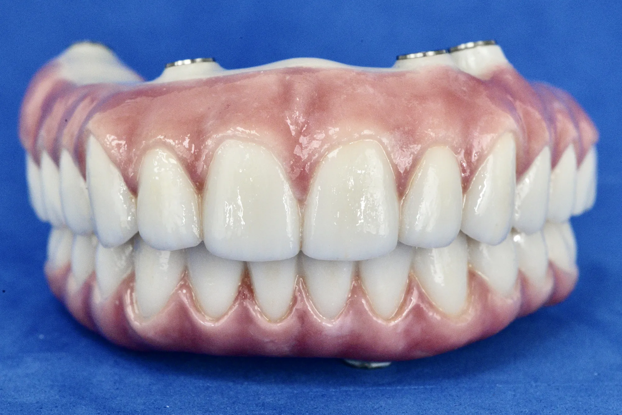 Prótesis de zirconia monolítica