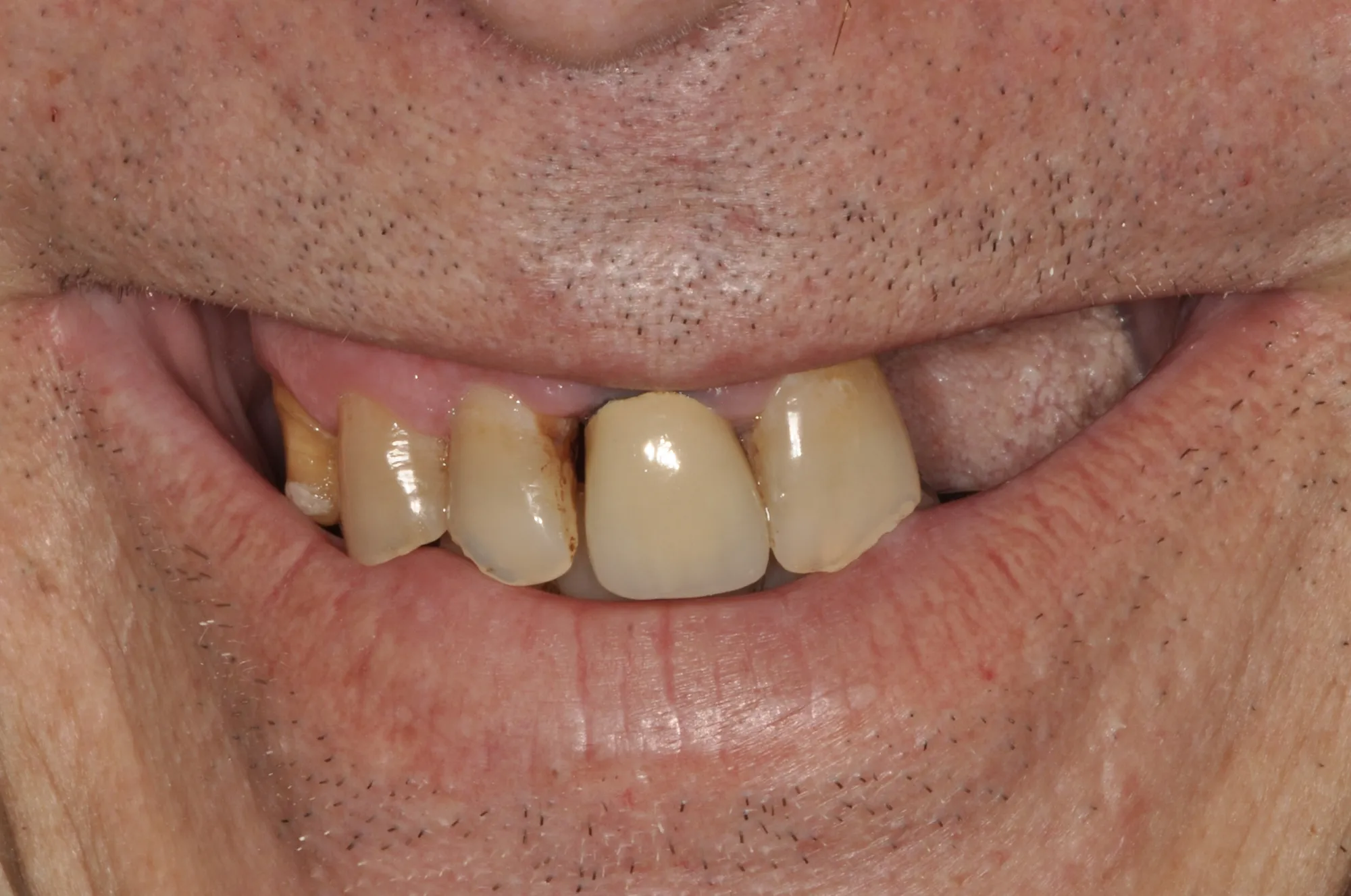 Antes