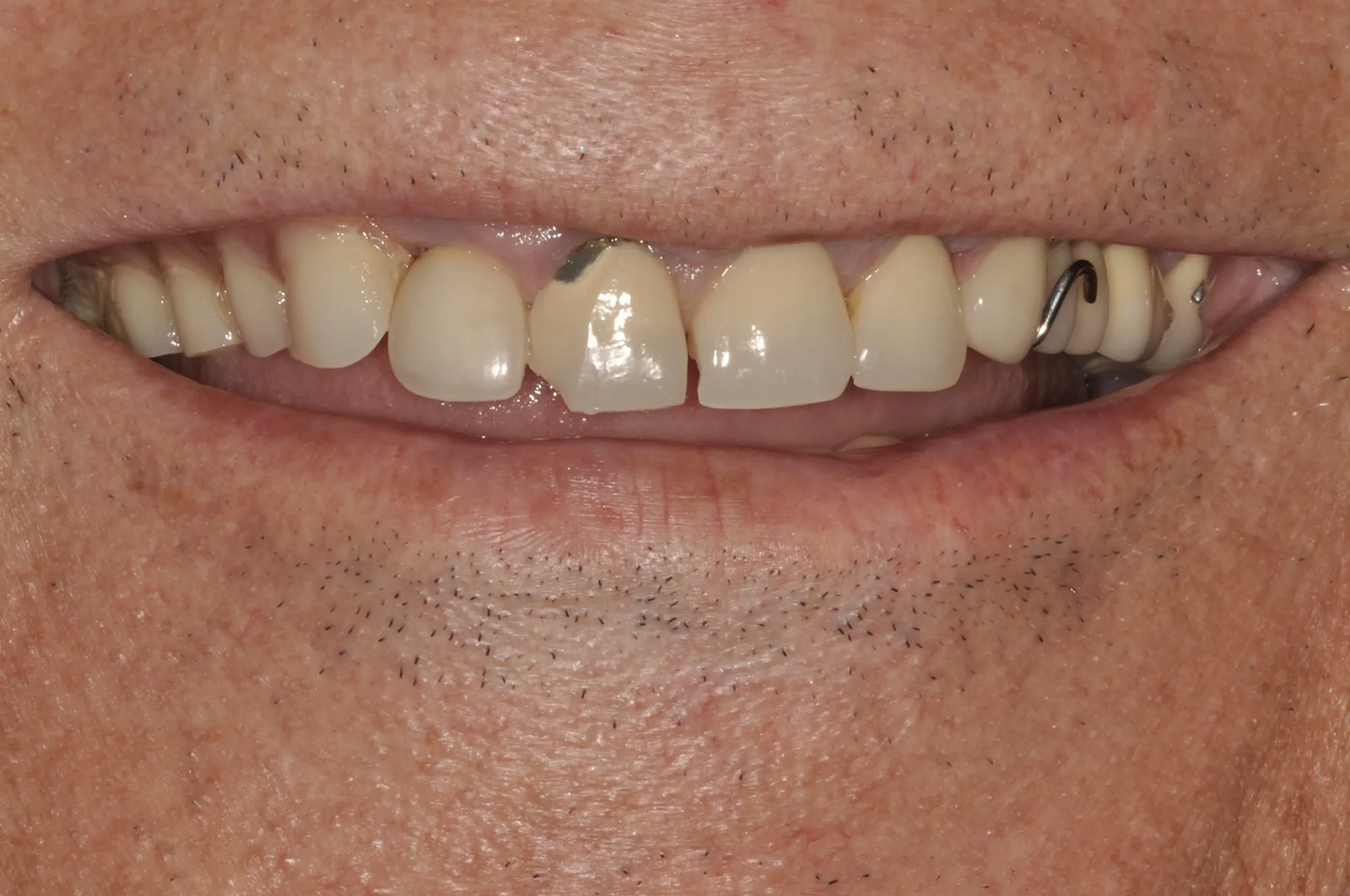 Antes