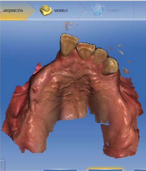Escáner intraoral