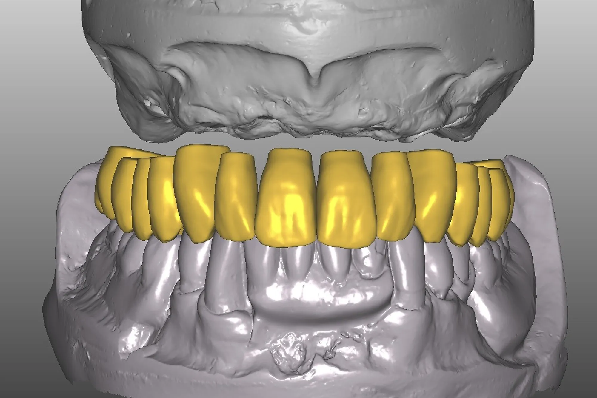 Prótesis de zirconia monolítica